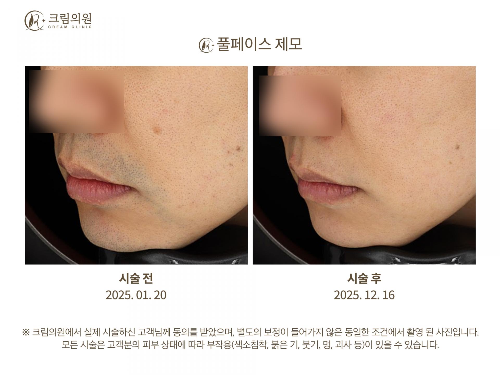 레이저제모 이미지