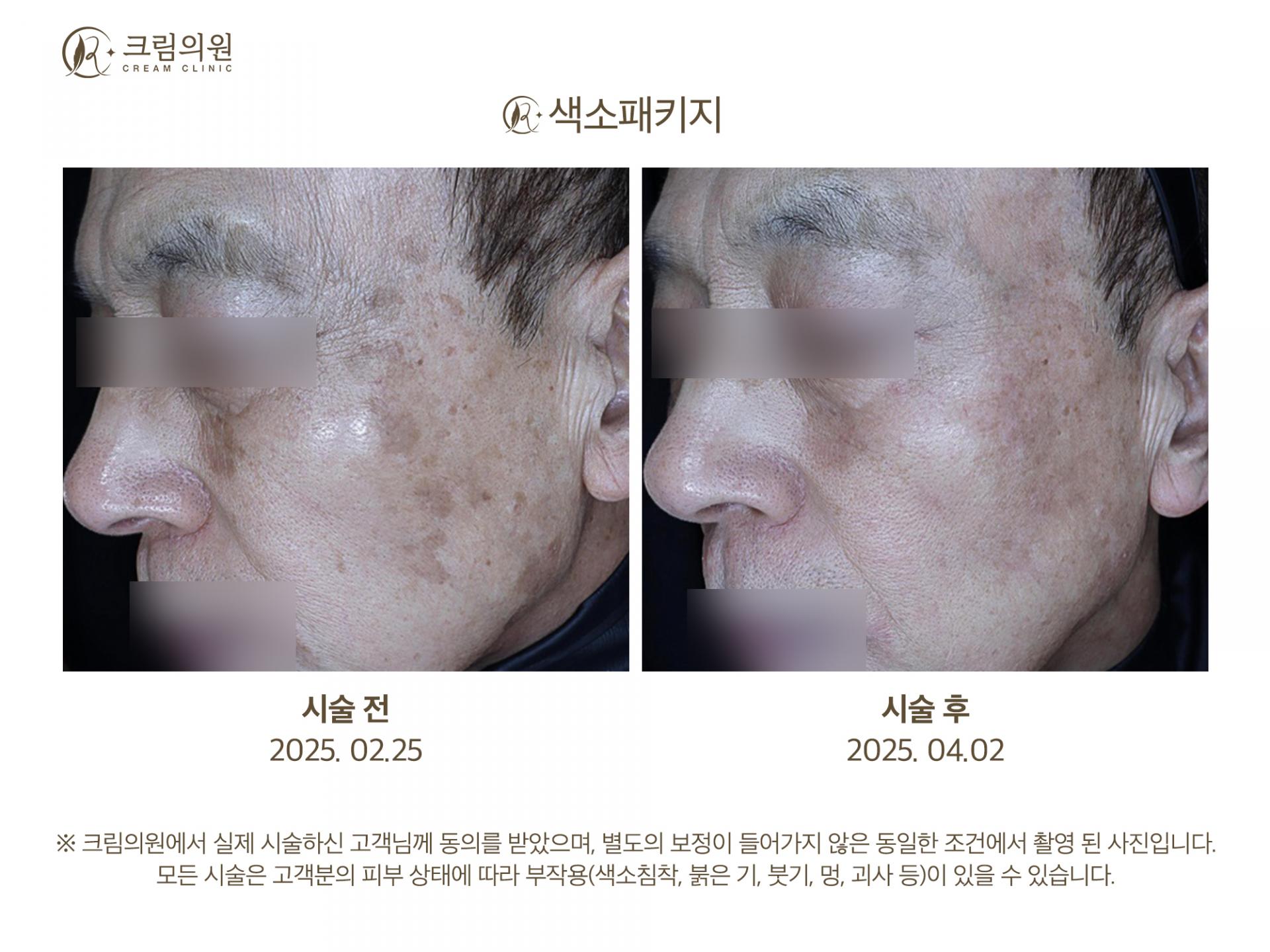 색소패키지 이미지