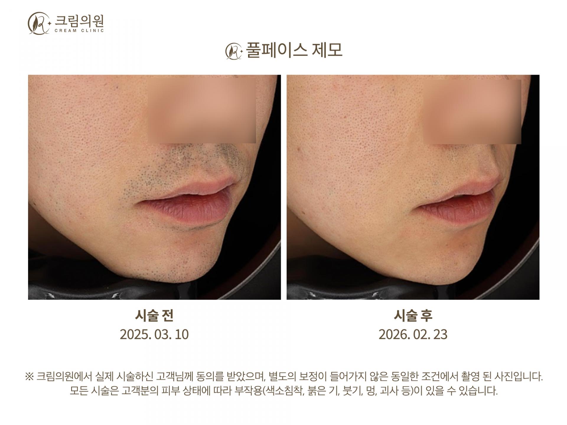 레이저제모 이미지