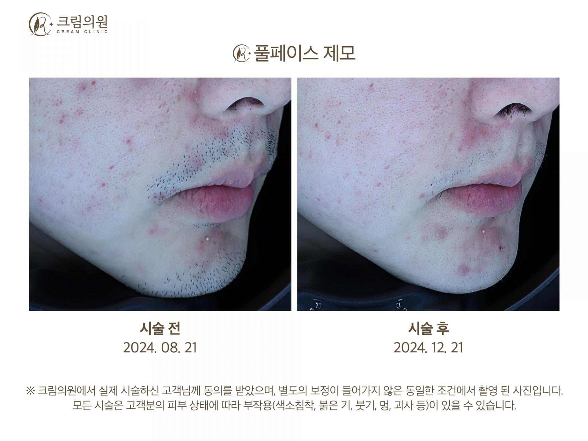 레이저제모 이미지