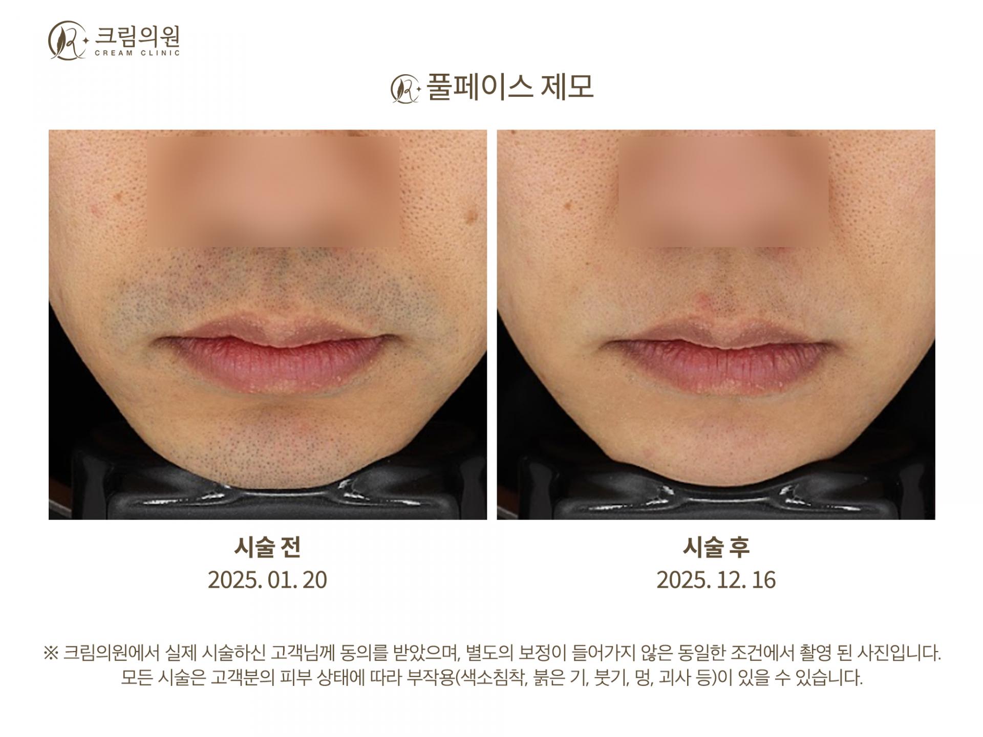 레이저제모 이미지