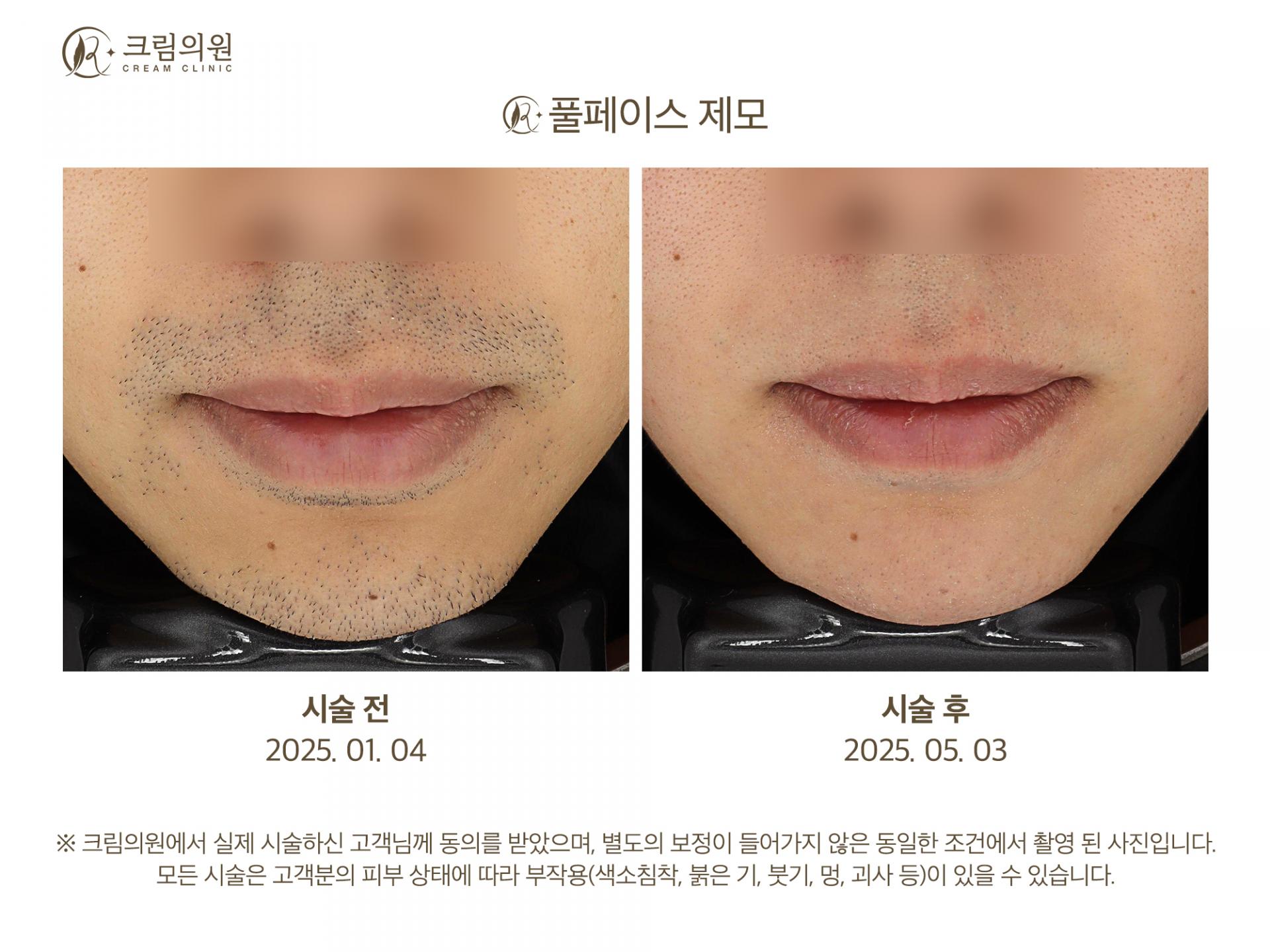 레이저제모 이미지