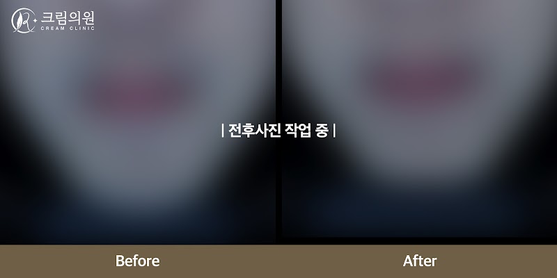 여드름/홍조 이미지
