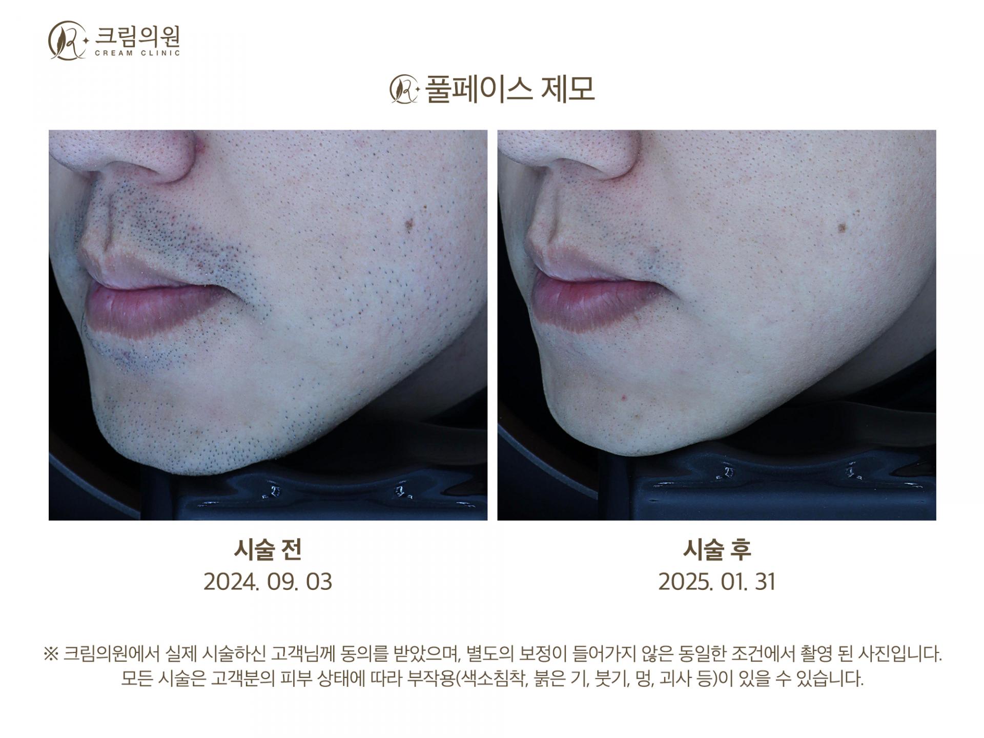 레이저제모 이미지