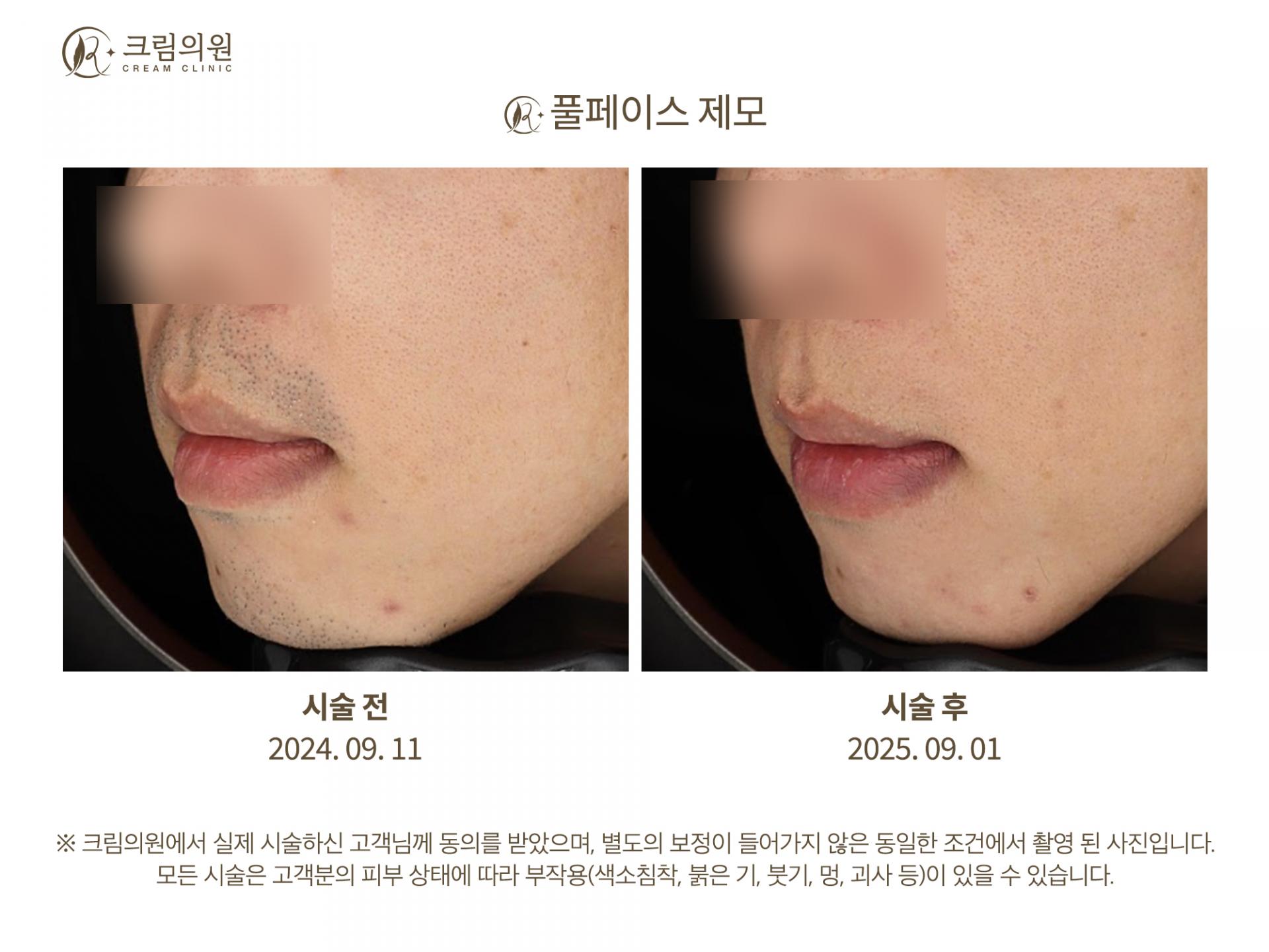 레이저제모 이미지