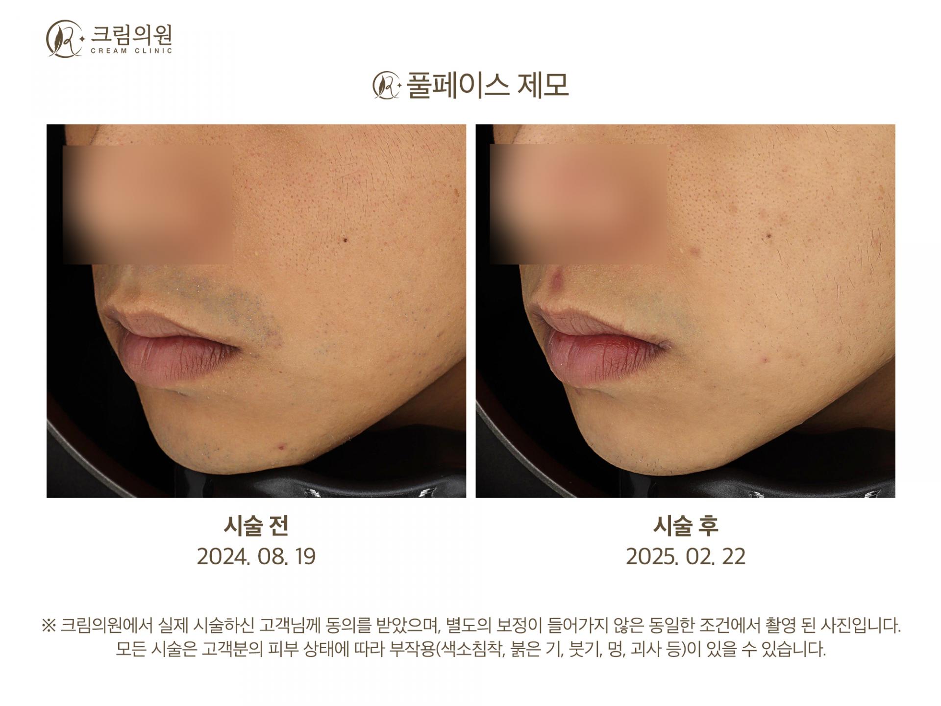 레이저제모 이미지