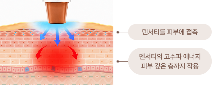 덴서티 피부 접촉 및 고주파 에너지 작용 도식