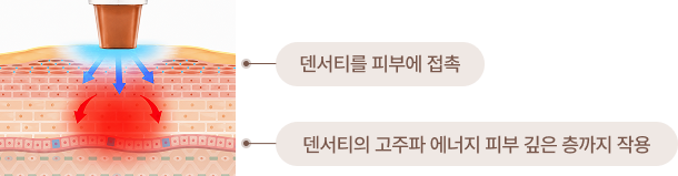 덴서티 피부 접촉 및 고주파 에너지 작용 도식