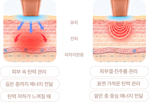 모노폴라·바이폴라 도식 (표피/진피/피하지방층)