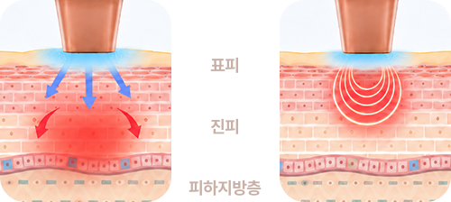 모노폴라·바이폴라 도식 (표피/진피/피하지방층)