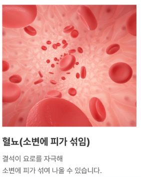 요로결석 혈뇨 증상