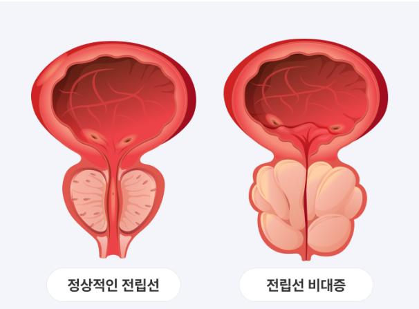 전립선비대증 질환 개요 및 구조