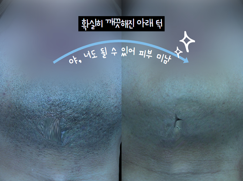 남자 수염 제모 후 깔끔해진 피부 변화
