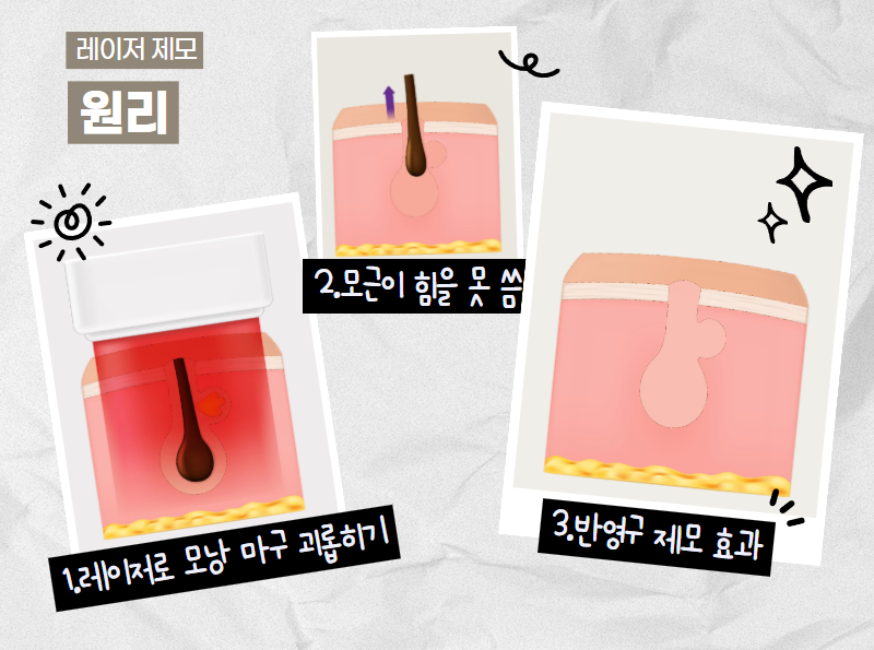 레이저 수염제모 후 피부 트러블 감소 모습