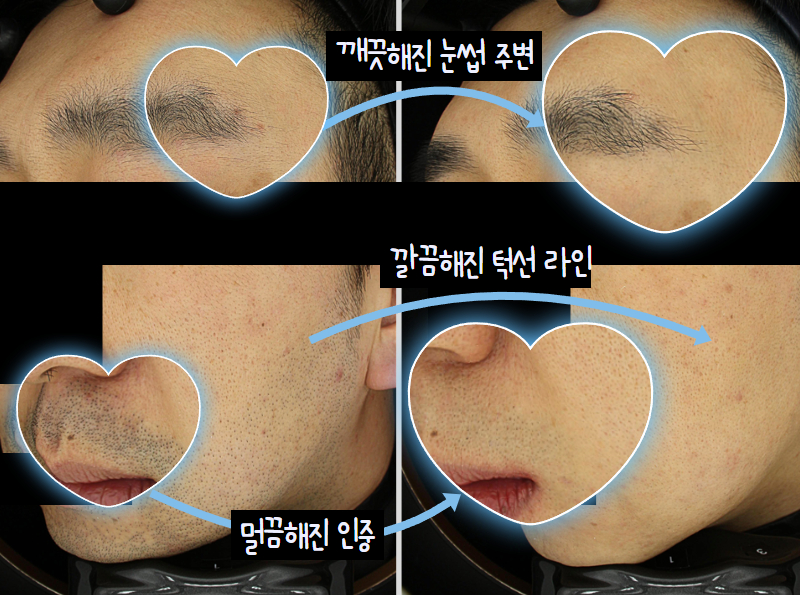 수염 제모 효과적인 횟수와 결과 사진