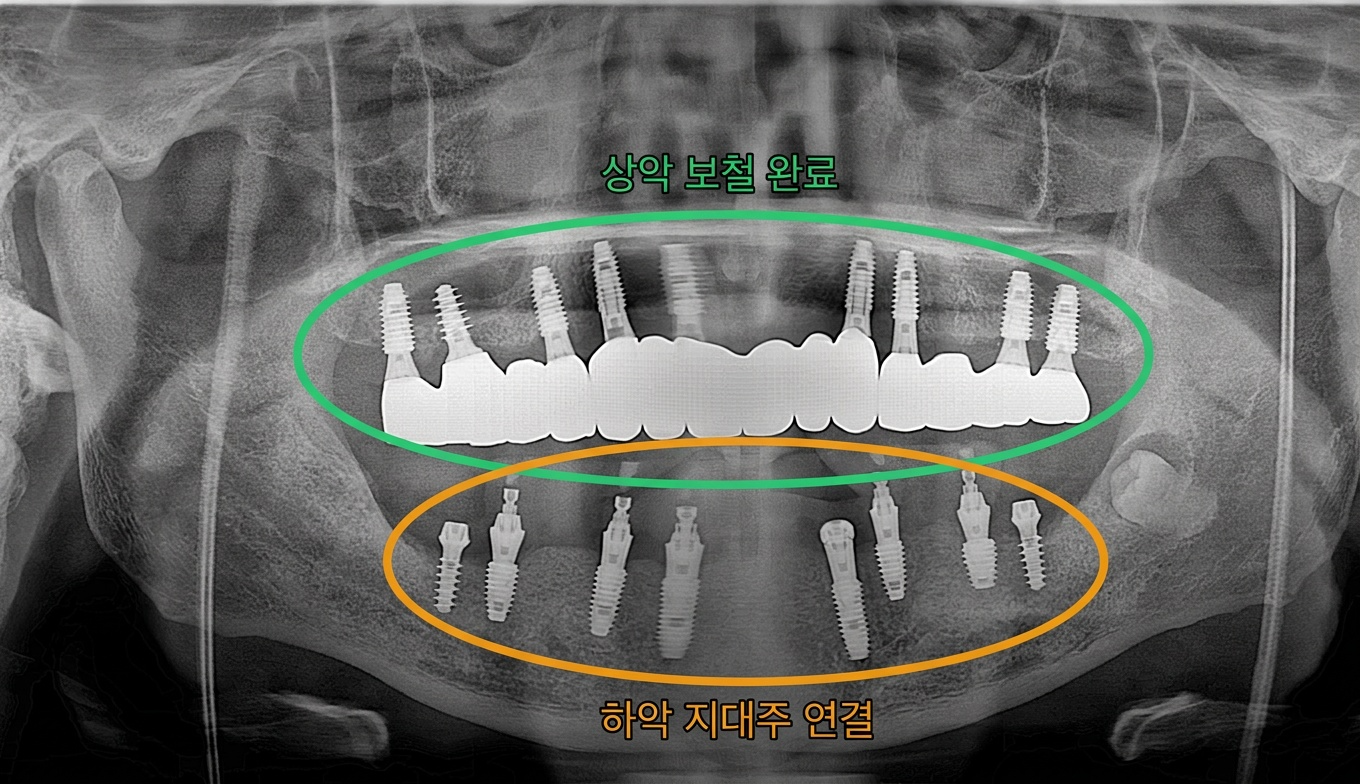 [치료 중] 상악 임플란트 상부 보철물 장착 완료