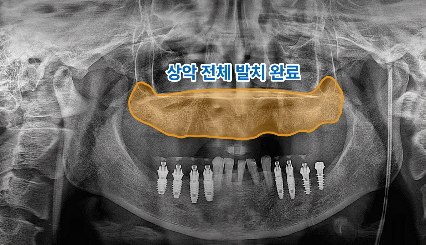 [치료 중] 상악 치아 모두 발치
