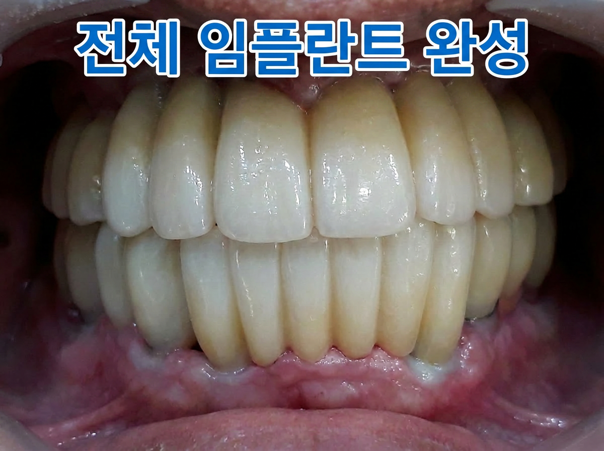 [치료 후] 상악 및 하악 보철물 제작 및 장착 완료 구내사진
