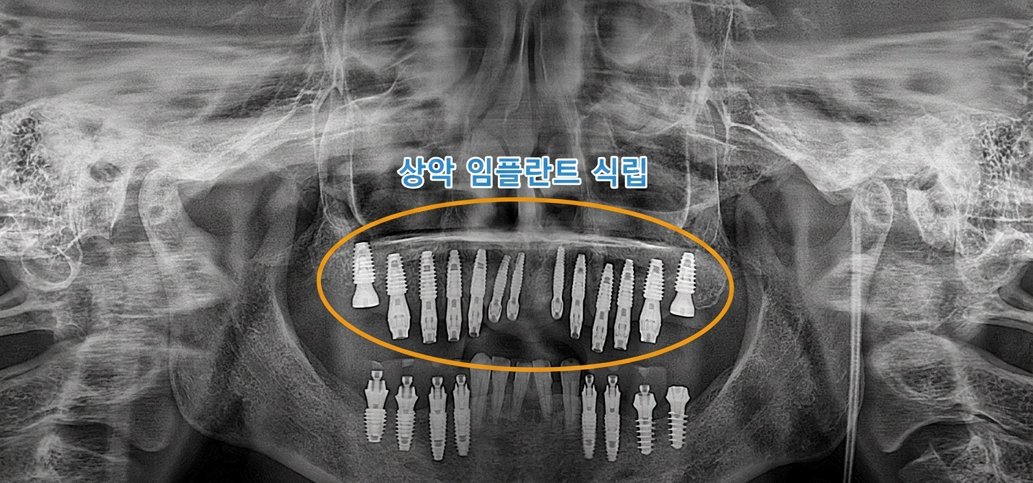 [치료 중] 상악 임플란트 식립