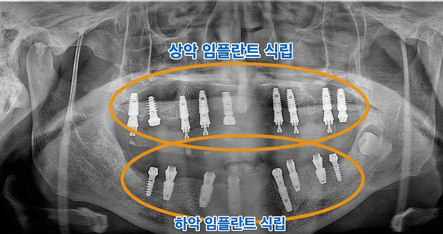 [치료 중] 상악 및 하악 전악 임플란트 식립