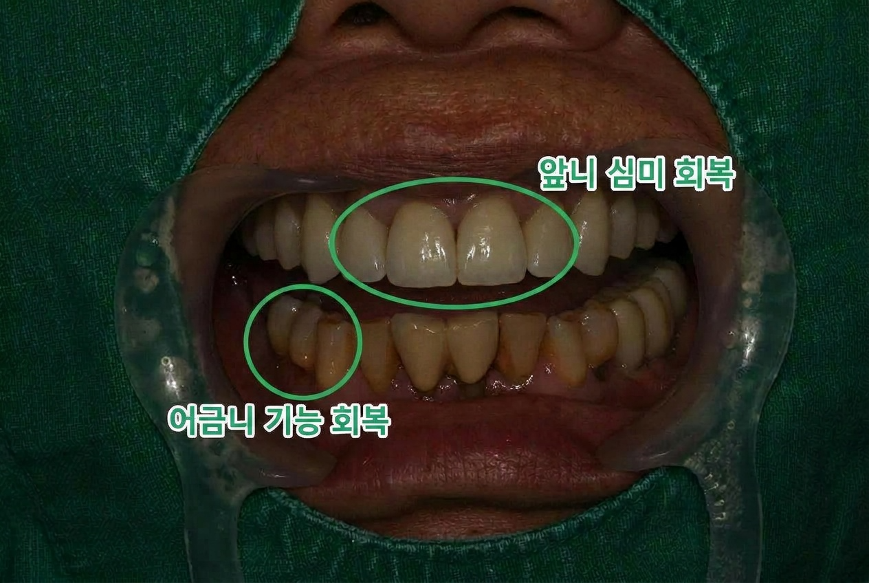 [치료 후] 보철물 장착된 사진