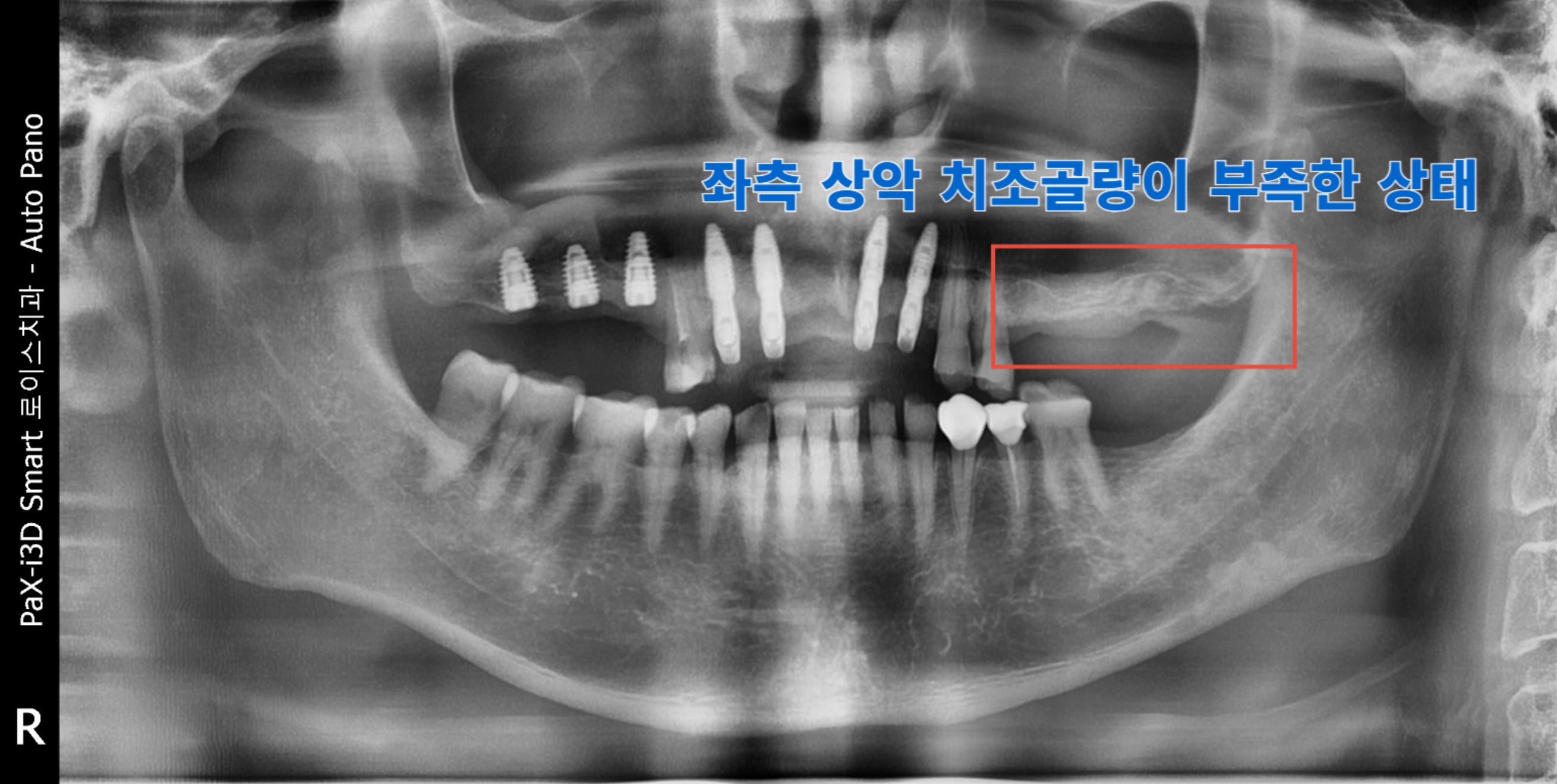 치료 전 상태