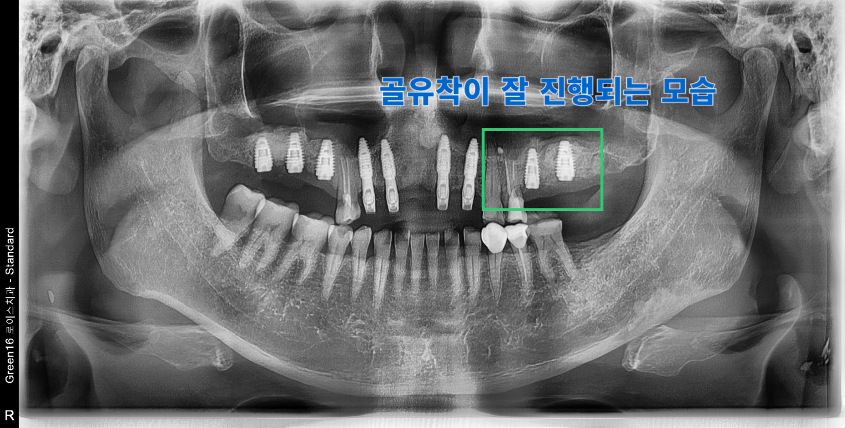 치료 중 상태
