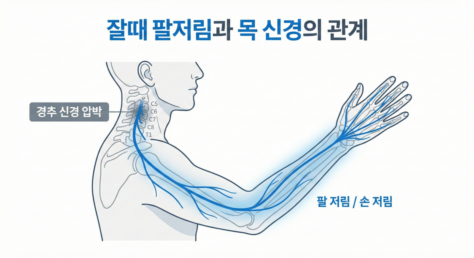 잘때팔저림 원인, 목 신경에서 팔로 이어지는 경추 신경 경로 설명
