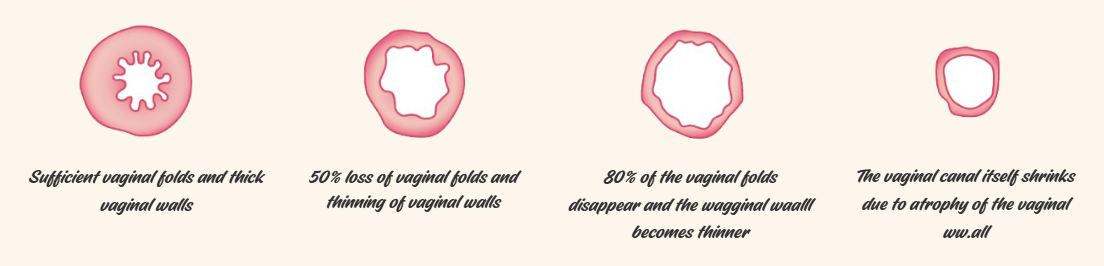 Vaginal rugae changes with age - elasticity and volume comparison at NAWE Women's Clinic