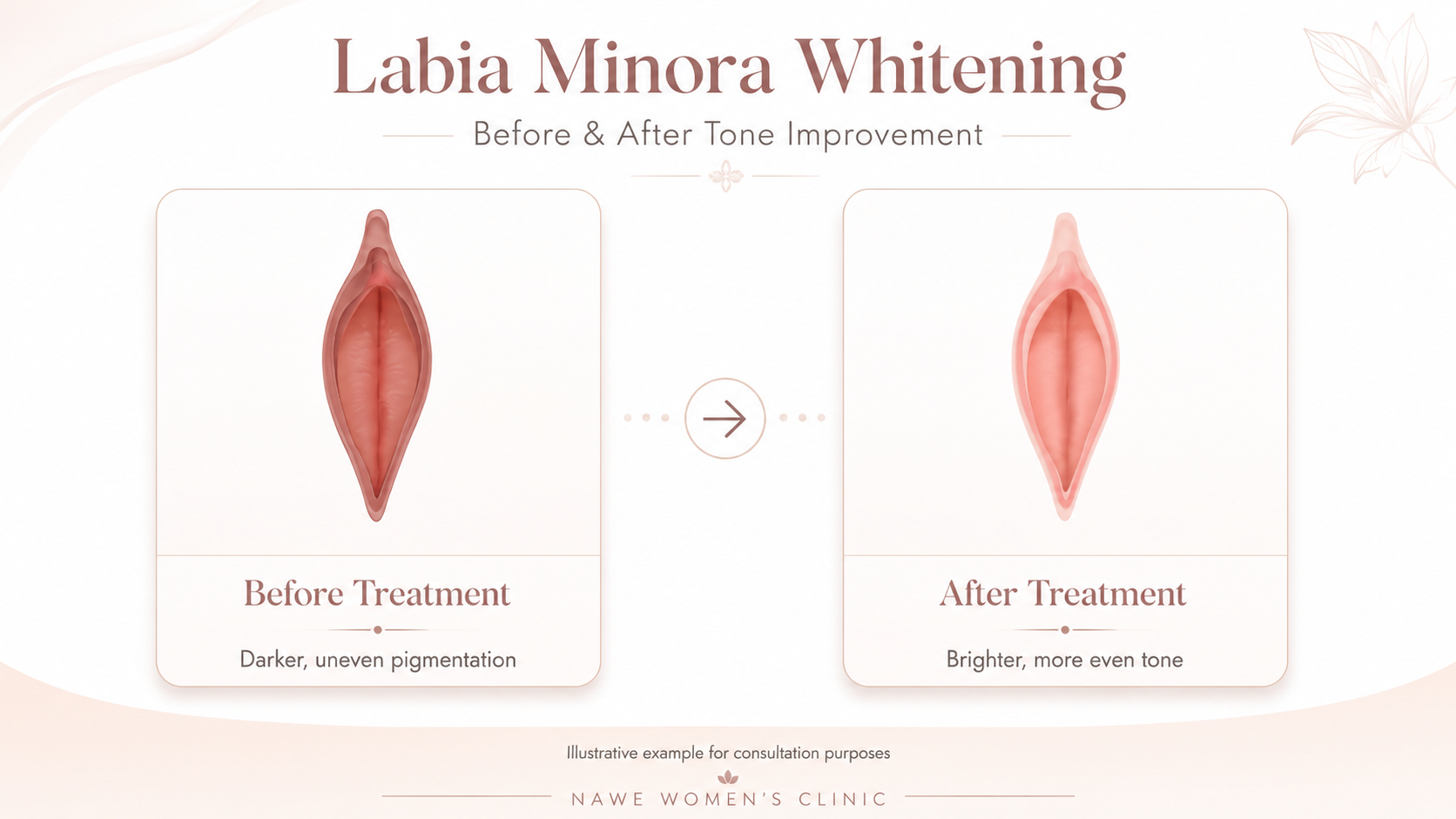 Labia minora pigmentation treatment procedure - NAWE Women's Clinic