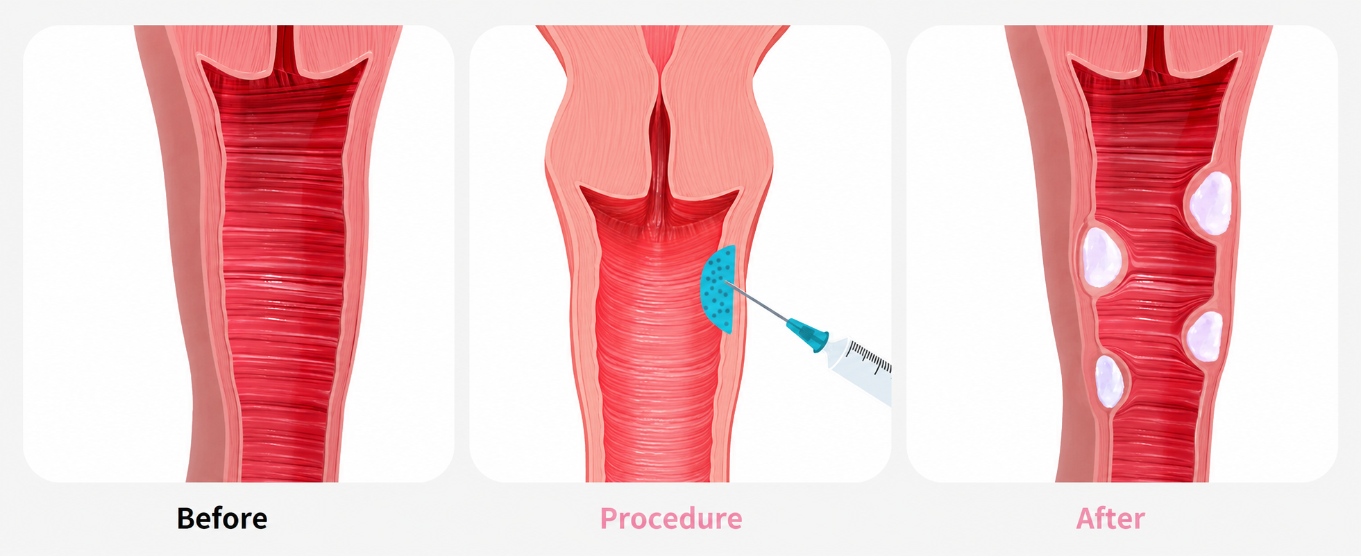 Vaginal filler injection process - personalized feminine volume care at NAWE Women's Clinic Korea