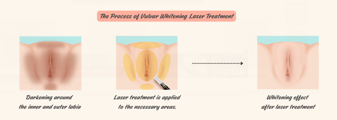 Intimate whitening laser treatment for vulvar pigmentation - targeting dark and uneven skin tone