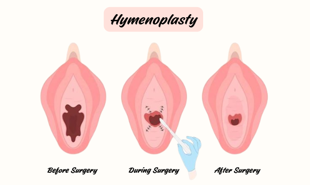 Hymenoplasty surgical method - direct repair and reconstruction overview