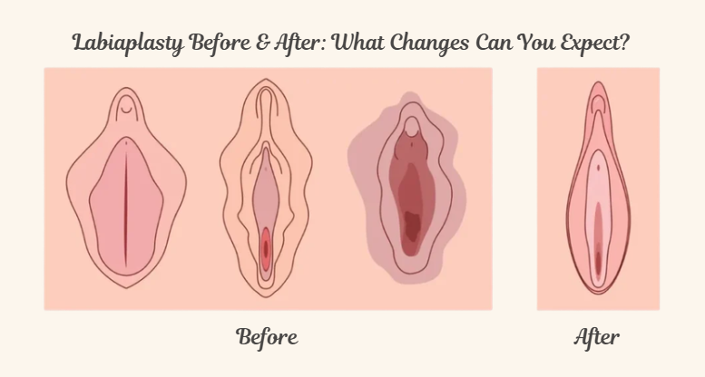 Labiaplasty before and after: reshaping the labia minora - NAWE Women's Clinic Korea