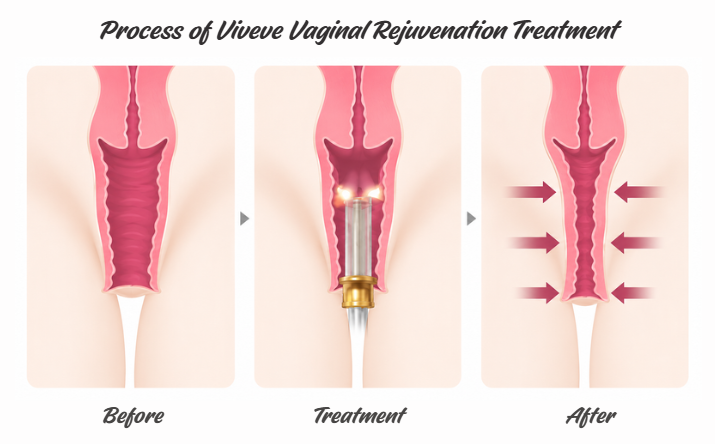 Viveve radiofrequency treatment mechanism for vaginal collagen remodeling - NAWE Women's Clinic Korea