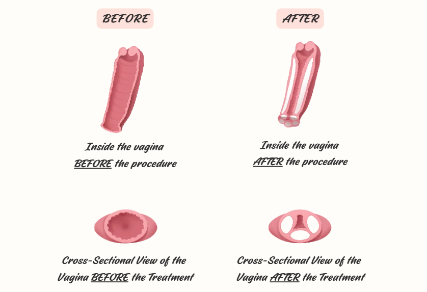 vaginal filler injection treatment explanation - elasticity and contraction improvement
