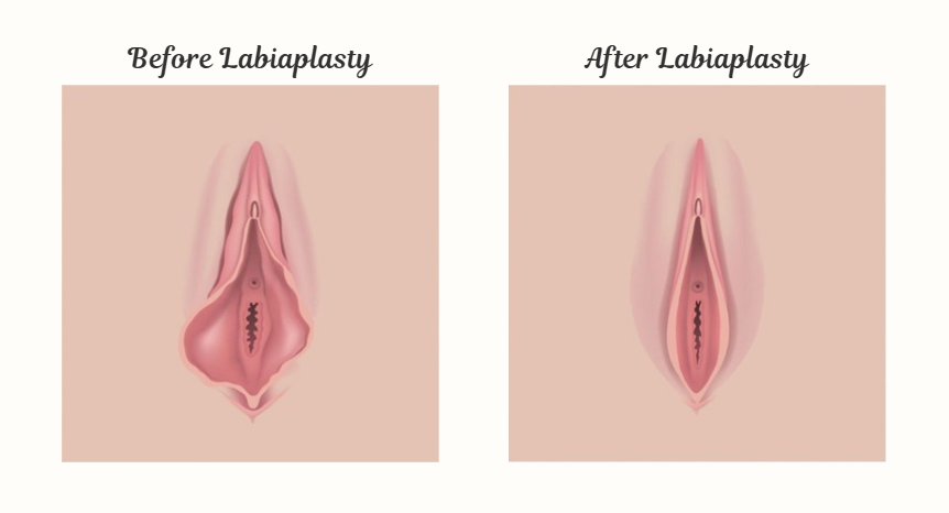 Labiaplasty procedure explanation - labia minora reshaping surgery at NAWE Women's Clinic Korea