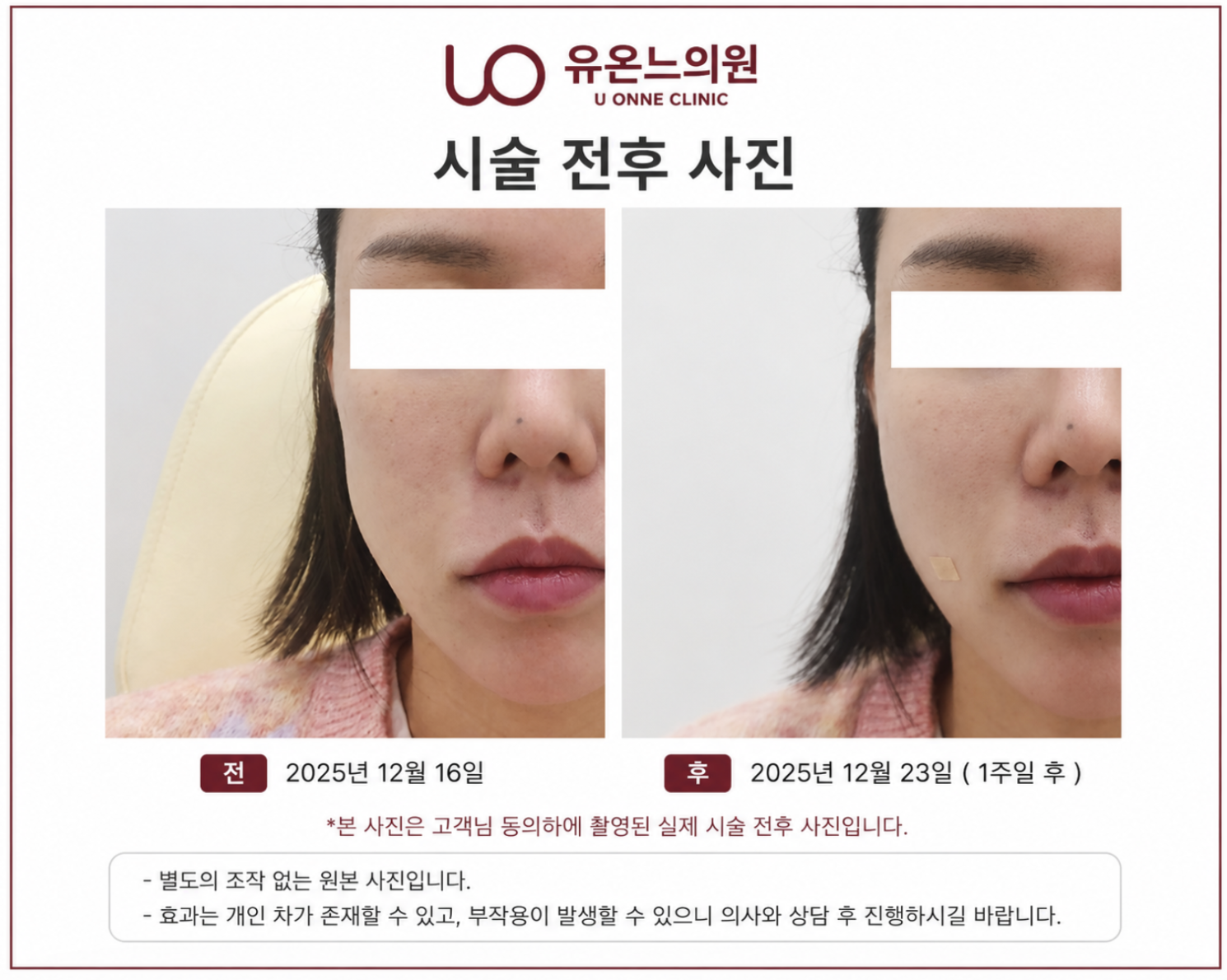 힐로웨이브 전후사진 - 시술전과 시술 1주일 후 비교, 유온느의원