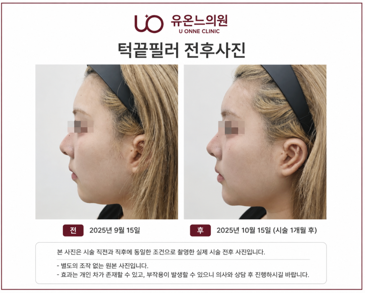 턱끝필러 전후사진 - 시술 전과 1개월 후 측면 얼굴 윤곽 비교 | 유온느의원