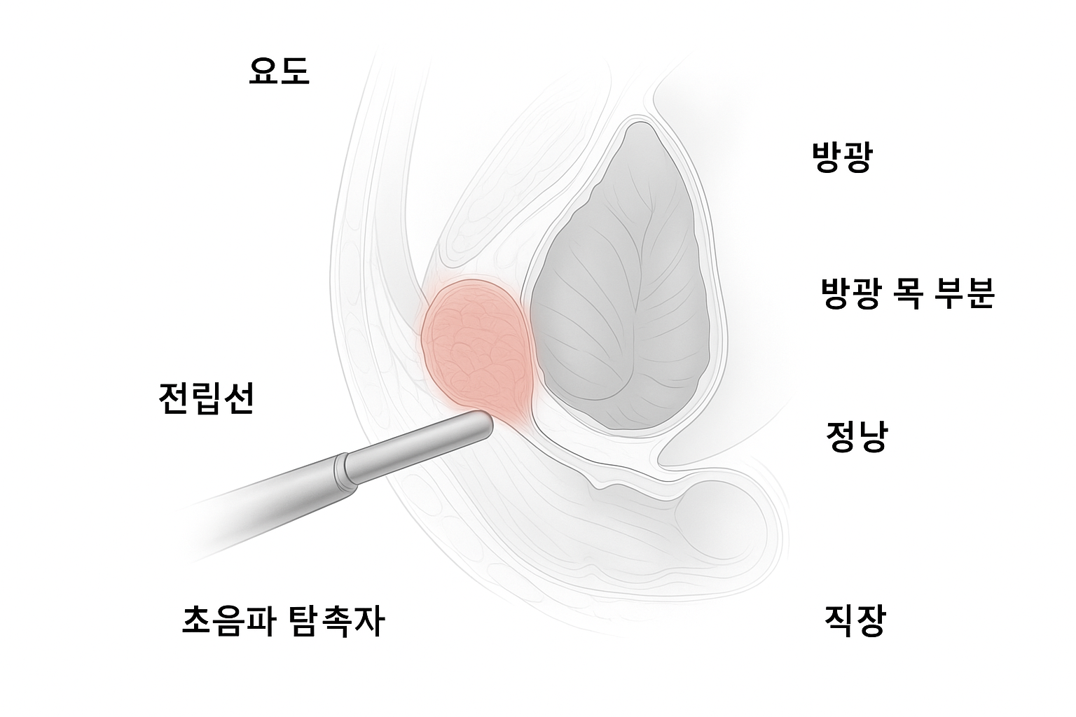 경직장전립선초음파