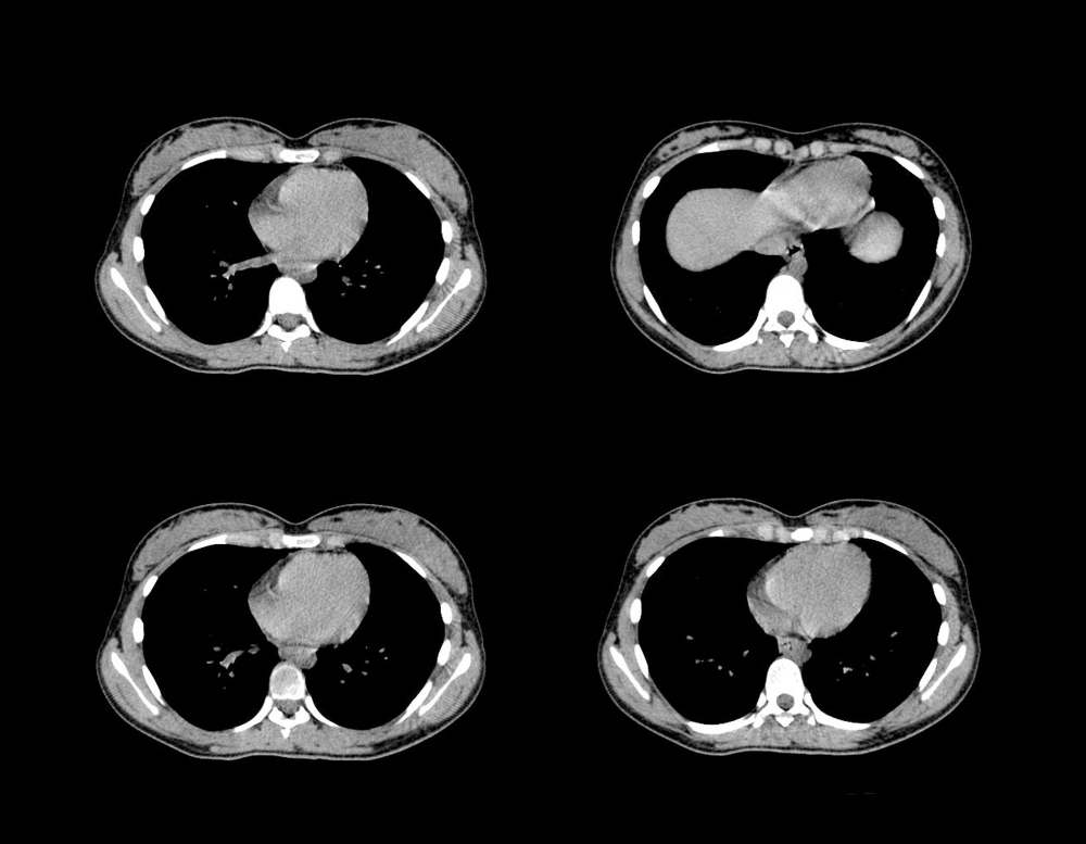 남성갱년기증상설문