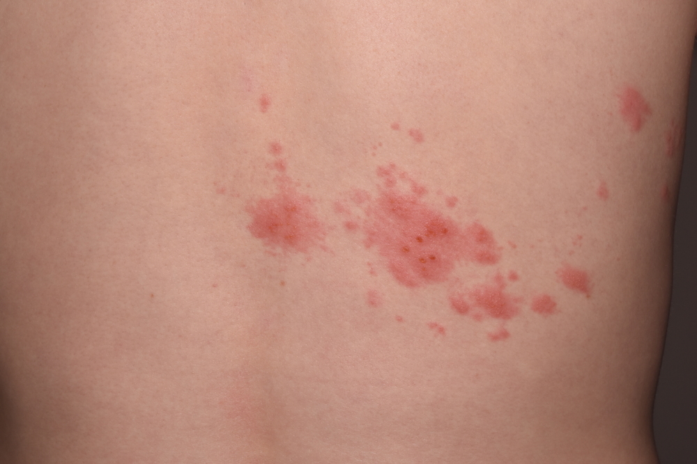 발진과 수포 증상