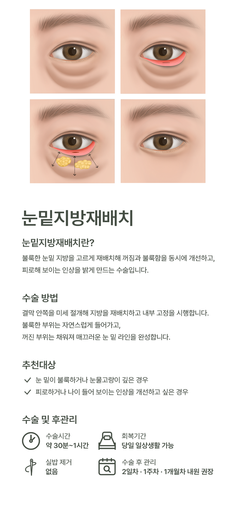 눈밑지방재배치 이미지