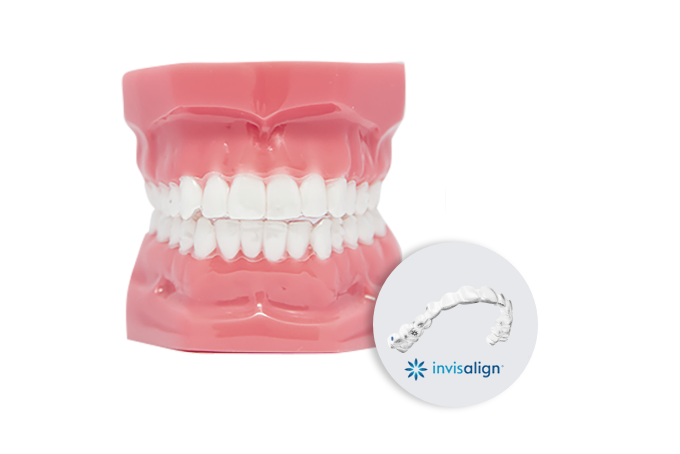 인비절라인 교정 이미지