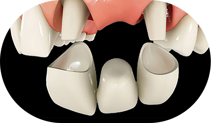 올세라믹 이미지
