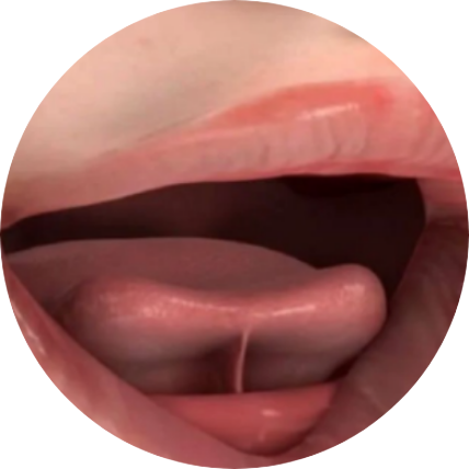 설소대 절제 수술