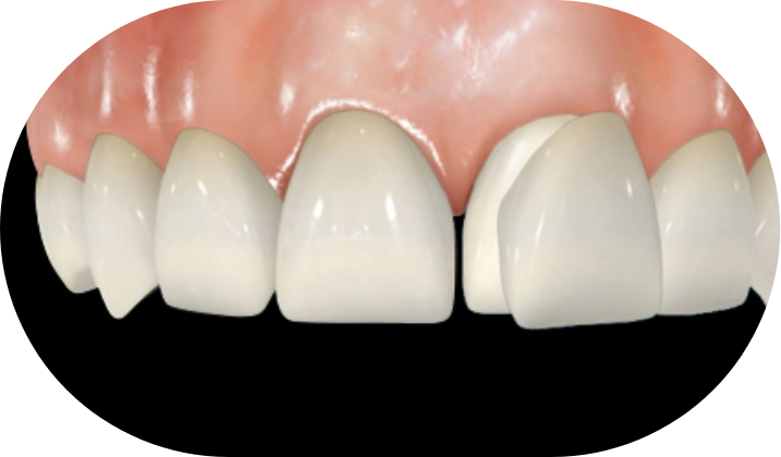 무삭제 라미네이트 이미지