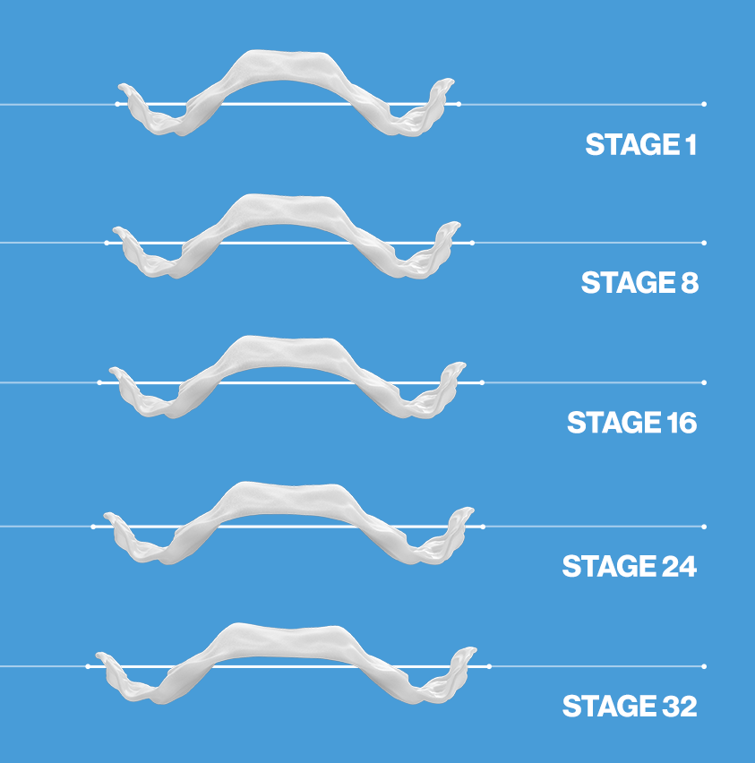 부분교정 MTA 이미지
