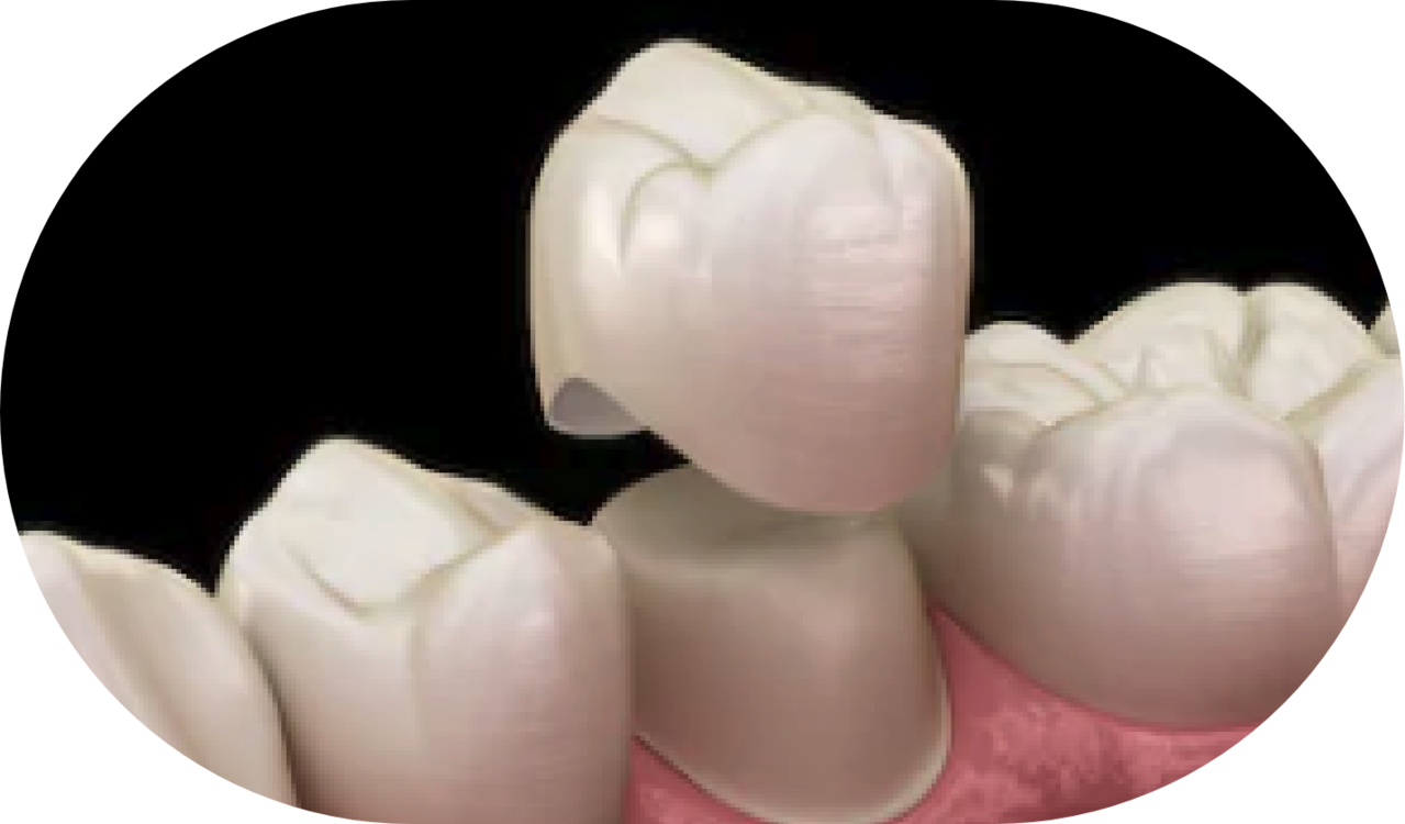 지르코니아 이미지