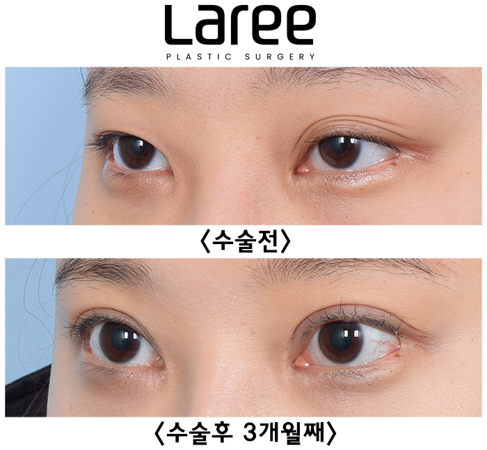 매몰쌍수 한쪽 풀림현상, 여러겹쌍꺼풀 절개재수술눈매교정 후 변화 : 라리성형외과